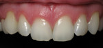 Figure 9 - This patient’s chipped incisors with a rotated cuspid were treated with enameloplasty performed on all four incisors and a porcelain laminate on tooth No. 6 to correct the rotation.