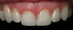 Figure 10 - This patient’s chipped incisors with a rotated cuspid were treated with enameloplasty performed on all four incisors and a porcelain laminate on tooth No. 6 to correct the rotation.
