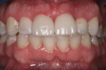 Figure 12 - This patient presented with crowding and fractured teeth due to trauma. Orthodontics were performed to correct crowding, and internal bleaching was done on tooth No. 9 and laminates were placed on teeth Nos. 8 and 9.