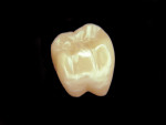 Figure 4 The final full-contour zirconia crown ready for delivery. Photography by Patrick Cavan Brown