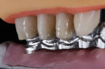 Figure 9 The denture teeth are transferred to the metal frame using the Verticulator and bisacryl.