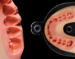 Figure 5 Two matrix styles: full contour (left) and occlusal (right).
