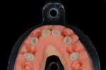 Figure 6 The prepared denture teeth are inserted into the full-contour matrix in the Verticulator lid.