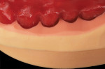 Figure 11 The occlusal matrix is used to reference the wax-up while cutting back.