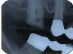 Figure 1   Examples of radial pulp enlargement internal resorption. Note well-defined, balloon-like enlargement within cervical and coronal areas of root canal system.