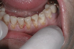 Figure 2 - A slow-speed handpiece with a #6 round bur was used to remove the decay and existing restorations.