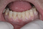 Figure 3 - An A-3 shade of the composite (Beautifil II) was placed using a titanium interproximal carver, and adapted to the internal line angles of each tooth and built to full facial contour.