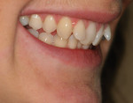 Figure 2 - This retracted, three-quarter view emphasizes the extreme proclined position of the right and left maxillary lateral incisors.
