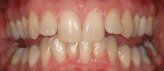 Figure 1 - Retracted view showing retroclined right and left maxillary central incisors.