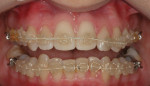 Figure 4 - After 4 months of Six Month Smiles short-term orthodontic treatment, the teeth were more aligned.