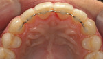 Figure 5 - Because the patient was a class 2 orthodontic patient with sufficient maxillary space, she could wear a fixed lingual retainer.