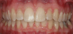 Figure 7 - Posttreatment retracted view after removal of the Six Month Smiles cosmetic braces showing a straighter, more esthetic smile.