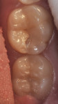 Figure 1 - The first molar presents lesion already on dentin, and the second molar presents an active lesion on enamel.