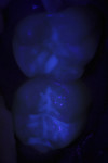 Figure 2 - The teeth were sealed with UltraSeal XT hydro under ultraviolet light.