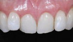 Figure 4 - Preoperative view of a patient who presented for enamelplasty and anterior direct composite veneers to correct the smile appearance.