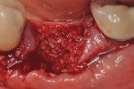 Figure 2 After debridement of the socket, FDBA was placed into it.
