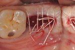 Figure 15 The barrier remained exposed at the time of suturing.