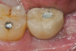 Figure 18 Final screw-retained crown was completed 4 weeks after implant placement.