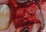 Figure 17 The site was re-entered at 28 weeks following extraction; some loss of ridge width was evident. Type II bone was encountered upon preparing the osteotomy and a 5-mm implant was placed.