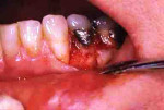 Figure 8  Photograph after flap was elevated (Fig 8). Note buccal resorptive defect; postoperative radiograph with gutta-percha fill of root canal and root defect filled with amalgam (Fig 9).