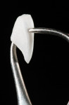 Figure 3 Veneers as thin as 0.2 mm can be fabricated from lithium disilicate. This requires ideal underlying tooth color, but nice esthetics can be achieved, as seen in Figure 4.