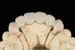 Figure 9 Higher translucency levels in zirconia reduce the need for layering. In this case, a full-contour design leaves the incisal edge in zirconia to prevent chipping.