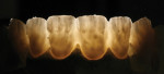 Figure 10 Note the light transmission through the high-translucency zirconia. Here, 0.6 mm of IPS e.max Ceram was added to the facial surface of the zirconia bridge in Figure 8.