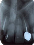 Figure 10  PARR with ankylosis. Note shortening and blunting of apical root of upper right central incisor with replacement of normal-appearing trabeculated bone, pulp obliteration, and loss of PDL. Note horizontal root fracture in adjacent left cent