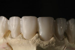 Figure 8 Higher translucency levels in zirconia reduce the need for layering. In this case, a full-contour design leaves the incisal edge in zirconia to prevent chipping.