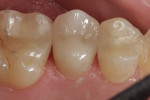 Figure 12 Monolithic lithium disilicate on tooth No. 4.