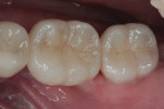 Figure 14 Lithium-disilicate crowns over the zirconia abutments in Figure 13.