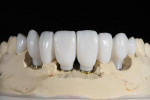 Figure 17 Zirconia abutments with PMMA provisional restorations designed with 3Shape software.