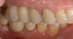 Figure 2 Implant-supported fixed partial denture.