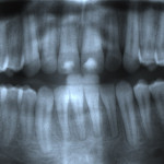Figure 13  TAB of lower incisors in orthodontic case after de-banding. Note small periapical radiolucencies with apical blunting of the lower incisors and cuspids. PARR without ankylosis in completed orthodontic case. Note shortening and blunting of