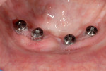 Figure 8 Edentulous implant case.