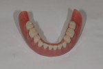 Figure 14 Occlusal surface of final removable prosthesis.