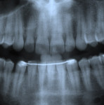 Figure 14  TAB of lower incisors in orthodontic case after de-banding. Note small periapical radiolucencies with apical blunting of the lower incisors and cuspids. PARR without ankylosis in completed orthodontic case. Note shortening and blunting of