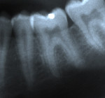 Figure 18  Localized apical idiopathic external resorption. Radiograph of lower left first molar in 2003 (Fig 18). Radiograph of lower left first molar in 2005 (Fig 19). Note replacement of distal apical root with normal-appearing bone (PARR without