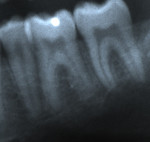 Figure 19  Localized apical idiopathic external resorption. Radiograph of lower left first molar in 2003 (Fig 18). Radiograph of lower left first molar in 2005 (Fig 19). Note replacement of distal apical root with normal-appearing bone (PARR without