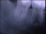 Figure 20  Radiograph of lower right first molar with cementoblastoma. Note mixed radiolucent areas with central irregular opaque areas between the roots. Note irregular surface resorption of the roots (images courtesy of Dr. Ray Melrose and Dr. Jan
