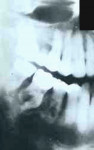 Figure 21  Radiographs of patient with Paget’s disease of bone. Note irregular, ragged resorption of the lower posterior teeth with both radiolucent and radiopaque areas in the posterior mandible (images courtesy of Dr. Ray Melrose and Dr. Jan