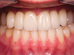 Figure 21 The increased over-jet and overbite of the anteriors resulted in a more youthful smile.