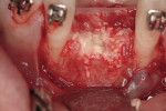 Figure 7  Bone allograft (FDBA) was placed to obturate the extraction sites.