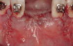 Figure 10  Primary wound closure was achieved; the patient subsequently presented to the orthodontist to replace the archwire; two denture teeth were attached to brackets for esthetic purposes.