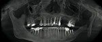 Figure 13  Pretreatment panorex demonstrating hopeless condition of maxillary dentition as well as mandibular molar teeth.