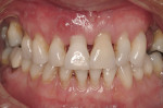 Figure 14  Severe periodontitis and periodontal abscess on the facial aspect of tooth Nos. 7 and 8. All maxillary teeth were hypermobile and the patient was symptomatic in the anterior sextant.