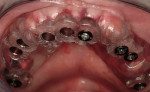 Figure 22  Surgical template, supported by the four remaining teeth and soft tissues. Sequential computer-guided implant placement was used to further stabilize subsequent implant insertions.