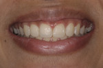 Figure 5. Smile view with direct mock-up showing final incisal edge positions of maxillary anterior teeth.