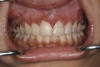 Fig 1. and Fig 2. Multiple carious posterior teeth after use of e-cigs. Fig 1: Gross caries on maxillary and mandibular right first molars; Fig 2: Gross buccal caries on a mandibular left first molar. (Reprinted with permission from Journal of Esthetic and Restorative Dentistry.28 Copyright 2020, John Wiley and Sons).