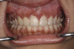 Figure 9. View of corrected gingival levels from teeth Nos. 4 through 13